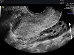 Diagnosing The Cause Of And Measuring Cul De Sac Fluid Empowered Women S Health