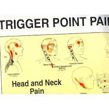 Trigger Point Pain Patterns Chart Poster Set Of 2