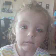 Little Mila is improving everyday since her eye surgery. I'm not sure how  much sight she has because she walks into things and doesn't know when  things she likes are right in