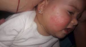 Buna seara ! Sunt noua in grup, si inca ma documentez si informez despre  dermatite si alte alergii (deci nu stiu foarte multe, dar sper sa culeg si  de aici informatii utile)