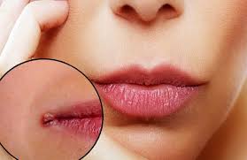 Cat swollen bottom lip causes | ownerlip.co. Heal Cracked Lip Corners With Home Remedies Cracked Corners Of Mouth Cracked Lips Lip Fungus