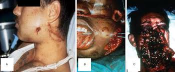 A slug wound, would be Ballistics Chapter 10 Color Atlas Of Emergency Trauma