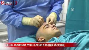 Saclariniz Dokuluyorsa Bir Sebebi Var Guncel Yasam Haberleri