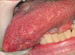 Bumps On Side Of Tongue White Red Causes And Effective Treatments Heal Panel Bumps On Tongue Tongue Treatment