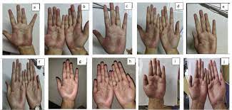 Ayurvedic Visha Hara Antitoxic Chikitsa In Recurrent Dyshidrotic Eczema Skin Disease A Case Report Sciencedirect