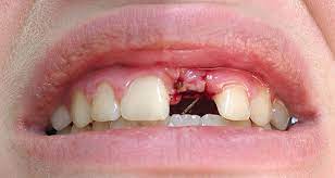 How Long Does It Take To Recover From A Dental Dental Implant Abroad