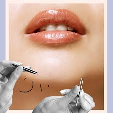 Hirsutism is excess hair growth on the body or face. Female Chin Hair 6 Things Hair On Your Chin Can Mean