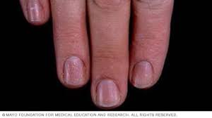 7 مشكلات في أظافر اليد لا ينبغي تجاهُلها - Mayo Clinic (مايو كلينك)