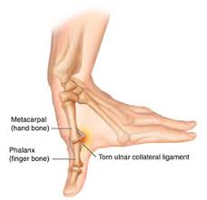 Grade 2 sprains can involve a ligament being partly torn, which can affect your range of movement grade 3 sprains are when the ligament is torn, sometimes fracturing the bone as it tears (avulsion fracture). Have I Got A Thumb Ligament Injury Manchester Hand Wrist Surgery