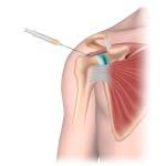 Image result for Biceps Tendon Injection