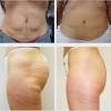 Can sweating get rid of cellulite? 1