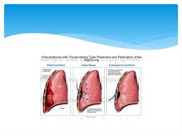 Heidrich h, ranft j, peters a. Pneumothorax Pneumothorax Atiologie Online Presentation