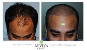 This Medical Clinic Has An Exclusive Hair Transplant Concept For Your Hair Regenerate Solve It All Hair Issue Best Hair Transplant Cool Hairstyles Hair Issues