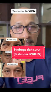 #eyebags dah kurang bengkak. Mata dah x merah, silau pun makin Ok.  Alhamdulillah slps makan supp Mata #IVXION. Yg penting product buatan JEPUN  ni HALAL. #rabun #matamerah #cataract #AbangMisai ...