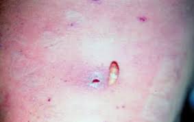 This occurs in tropical and subtropical areas. Kutane Myiasis Erkrankungen Der Haut Msd Manual Profi Ausgabe