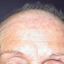 Itching, scabs, and dry flakes of skin that fall off and stick to the hair are symptoms. Causes And Treatment Of Frontal Fibrosing Alopecia Ffa
