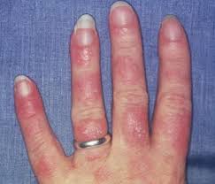 Systemic Lupus Erythematosus Sle Practice Essentials