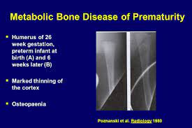 Metabolic Bone Disease Bone Study Day 28th September Ppt Video Online Download