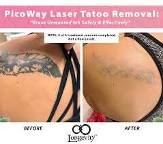 7 most frequently asked questions from tattoo removal patients. Tattoo Removal Okc 20 Off 1 Rated Med Spa Straightforward Pricing Longevity Med Spa