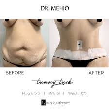 Offering the most affordable plastic surgery procedures. Mia Aesthetics Tummy Tuck Goals With Dr Mehio Miami Miababe Miaaesthetics Tummytuck Bodygoals Facebook