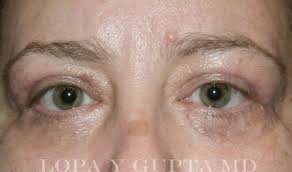Image result for xanthelasma of eyelid