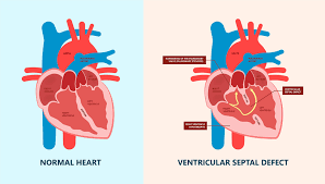 Image result for Ventricular Septal Defect