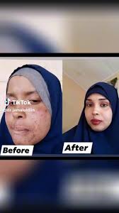 Soo dhowada asxbta aan jaceylhy spirulina waa dawo aad tayo sareysa wxy na  u fican tahay wajiga saliida leh, sido kale finanka ayey baa bi'isa wixi  faahfaahin ah WhatsApp number ka hoose