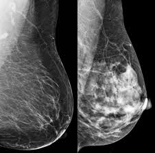 How does breast cancer look on a mammogram? What Does It Mean To Have Dense Breasts Cdc
