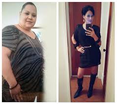 Pin On Gastric Bypass