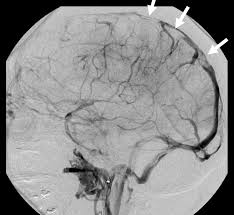 In six cases, a type of blood clot called cerebral venous sinus thrombosis (cvst) was seen in combination with low levels of blood platelets. Diagnosis And Management Of Cerebral Venous Thrombosis Stroke