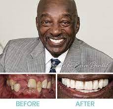 Dental Implants Cost in Kenya