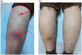 Image result for erythema nodosum