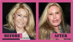 Catwoman Plastic Surgery Is One Of The Worst Ever Plastic Surgery Surgery Celebrity Plastic Surgery
