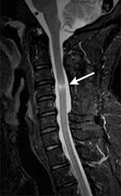 Backbone is becoming wildly popular as a web application development framework. Diagnostic Approach To Intrinsic Abnormality Of Spinal Cord Signal Intensity Radiographics