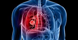 November is lung cancer awareness month. Spotlight Lung Cancer Research In Liverpool Institute Of Systems Molecular And Integrative Biology University Of Liverpool
