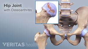 Overall, this muscle type enhances body posture while allowing you to slay deadlifts and squats. What S Causing My Hip Pain
