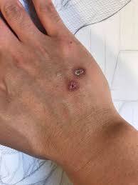 Image result for Tarantula Bite