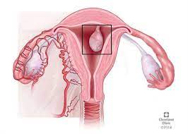 This type is quite uncommon and usually begins in the muscles surrounding the womb and gradually spreading inwards to the uterus. Uterine Polyps Causes Symptoms Diagnosis Treatment