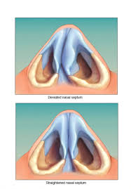 Aorta perut yakni pembuluh darah yang membawa darah dari jantung ke perut. Tulang Hidung Bengkok Senget Nh Ent Specialist Facebook