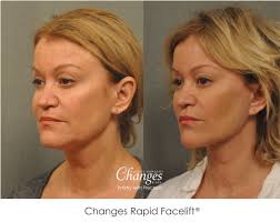 We did not find results for: How To Eliminate Sagging Jowls Arxiusarquitectura