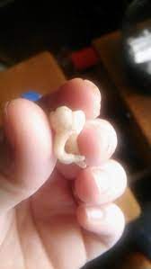 The Root Of My Wisdom Tooth Grew In A Hook Shape Mildlyinteresting