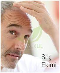 Sac Ekimi Fue Sac Ekimi Fiyatlari Sac Ekimi Sonrasi Sac Ekimi Nasil Yapilir Http Www Barankul Com Estetik Sac Ekimi