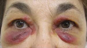 Image result for Angioedema