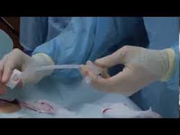 Initial Placement Of The Endovive Safety Percutaneous Endoscopic Gastro Peg Tube Peg Tube