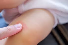 Este vorba de vreo alergie sau vrei toxiinfectie ? Impetigo Bube Dulci La Copii Cum Arata Bubitele Revista Baby Pentru PÄƒrinti È™i Copii