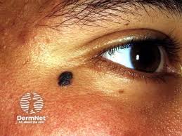 Image result for Spitz Nevus