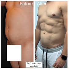 Visit this page to learn about the business and what locals in … 4 Beauty Aesthetics Institute Inc Constantino G Mendieta Md Facs Bodybymendieta Mens Have The Right To Get Drmendieta S Touch Too If You Are Interested In A Consultation