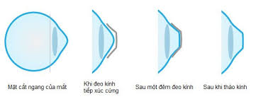 Kính áp tròng cứng là gì? - Liệu bạn đã biết về loại kính áp tròng này?