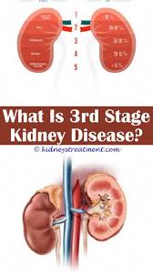 Kidney Clean All Natural Important Factors Need To Understand And Also Understand Kidney Feature In 2020 Kidney Disease Kidney Disease Symptoms Kidney Infection