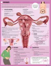 El cáncer de útero también puede causar otros síntomas, como dolor o presión en la zona pélvica. Miomas Bultos Benignos Pero Molestos Ahi Abajo Salud Ediciones